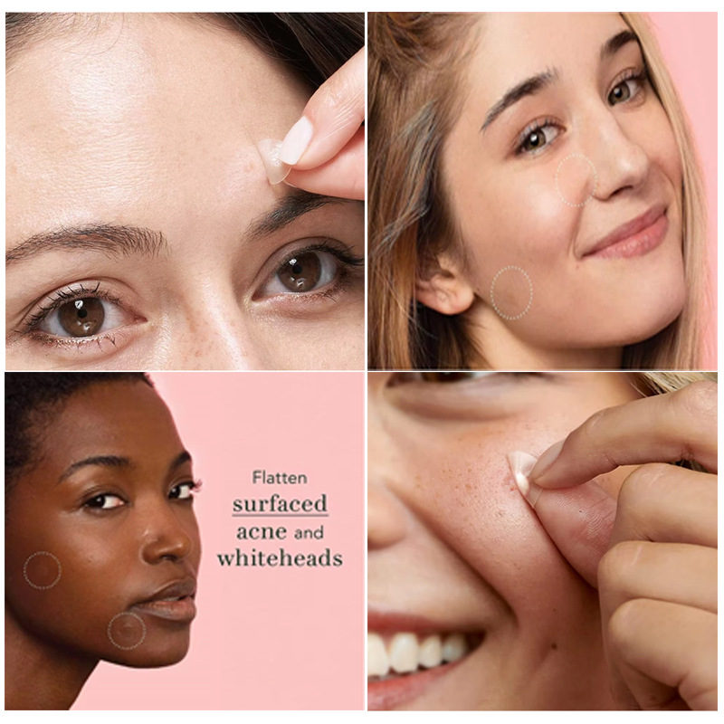 Acne Pimple Master Patch (51 patches) - Image 4